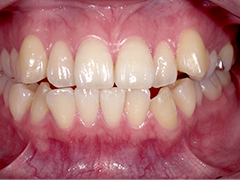 ホワイトニング前