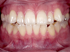 ホワイトニング後