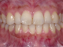 ホワイトニング前