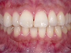 ホワイトニング後